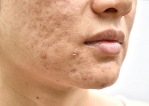 acne cravos espinhas diferença 1