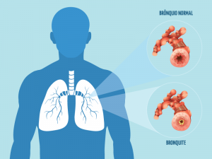 bronquite 3