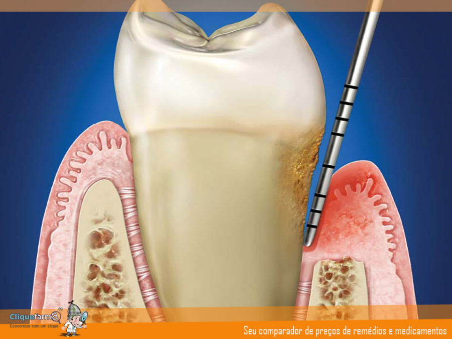 Doença Periodontal: Causas, Sinais e Sintomas | CliqueFarma