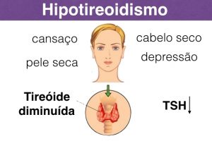 tireoide hipotireoidismo 1