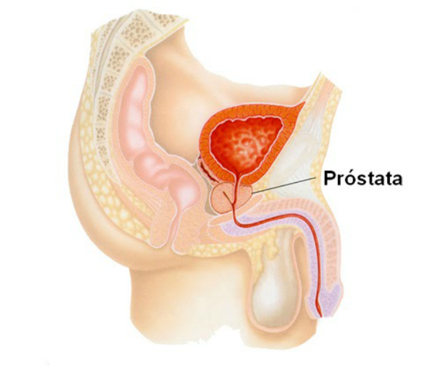 líquido prostático no completo para líquido prostático no completo para