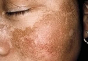 melasma 2