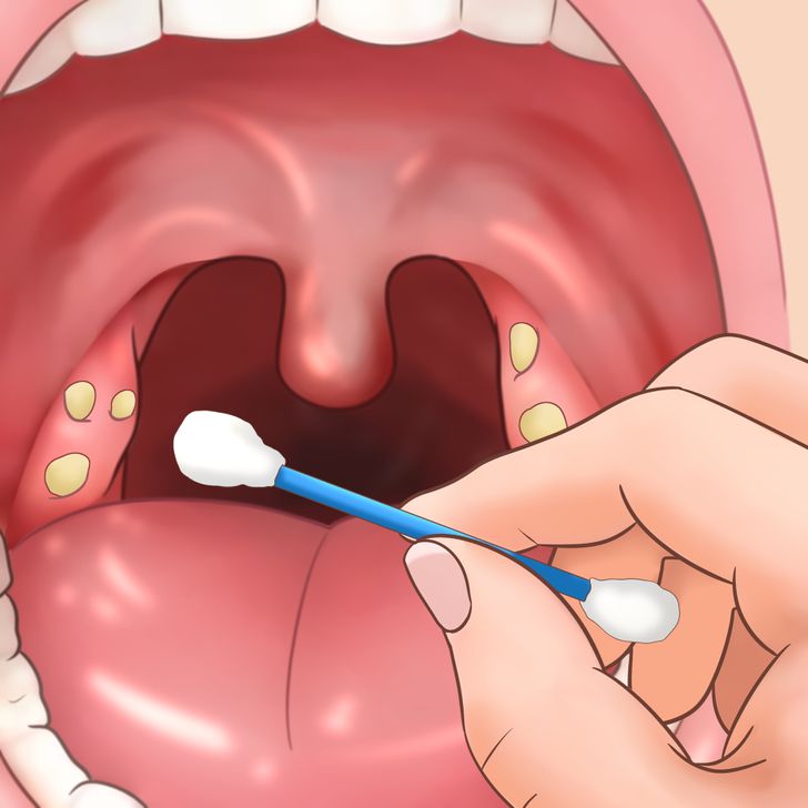 CASEUM: AS MASSINHAS FEDORENTAS DA GARGANTA – Clínica Rhinus