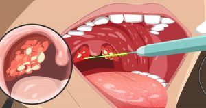 Bolinhas brancas na garganta? Entenda o que é a amígdala caseosa