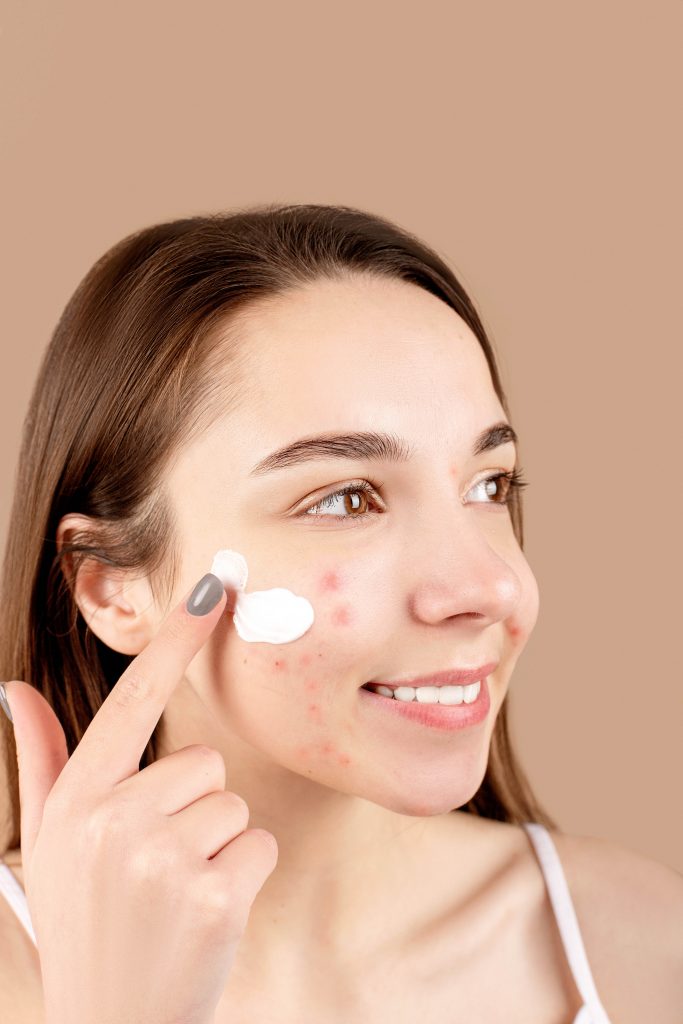 Mulher aplicando produtos antiacne na pele do rosto