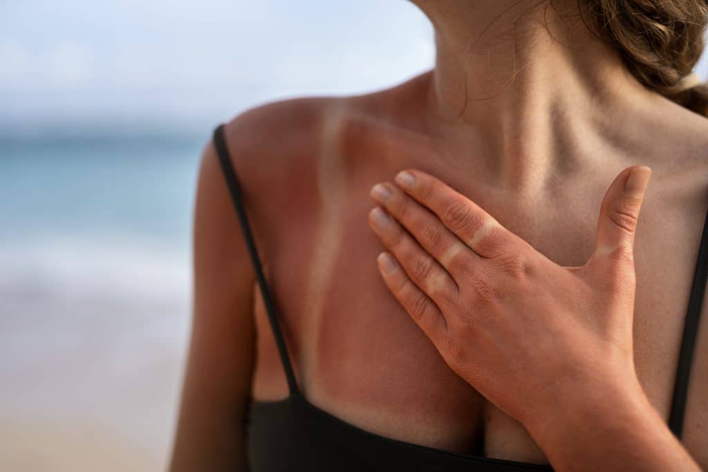 Mulher com marcas de queimaduras pós sol na pele