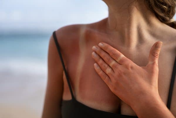 Mulher com marcas de queimaduras pós sol na pele