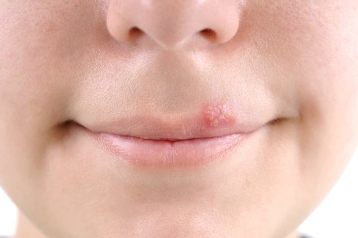 imagem de herpes labial