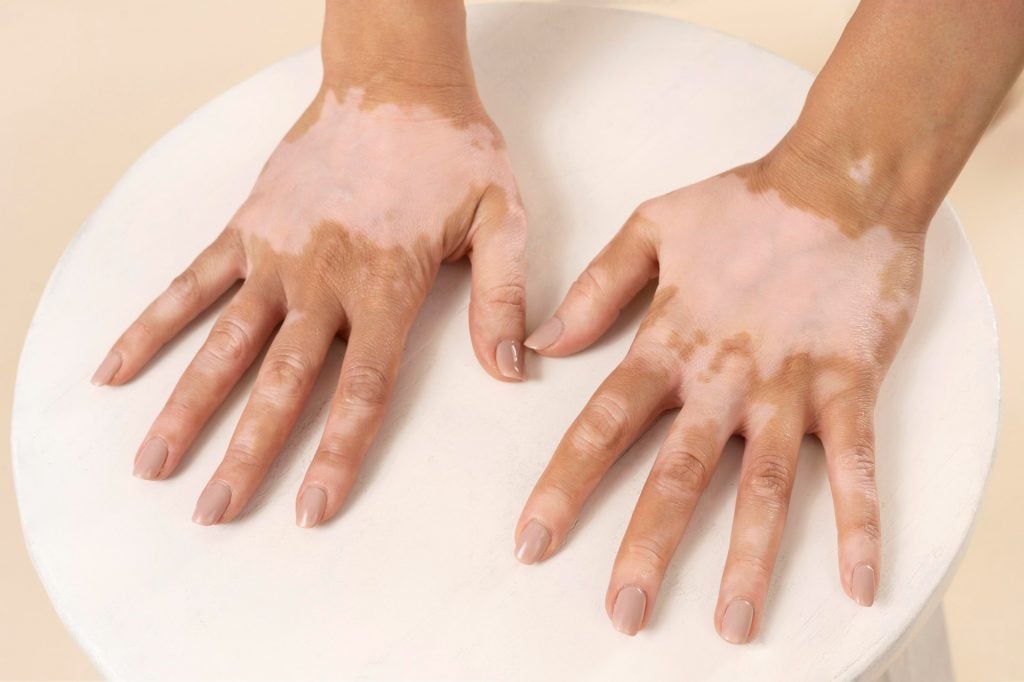 Vitiligo: Imagem de Freepik.