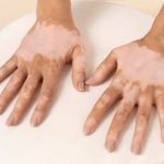 Vitiligo: Imagem de Freepik.