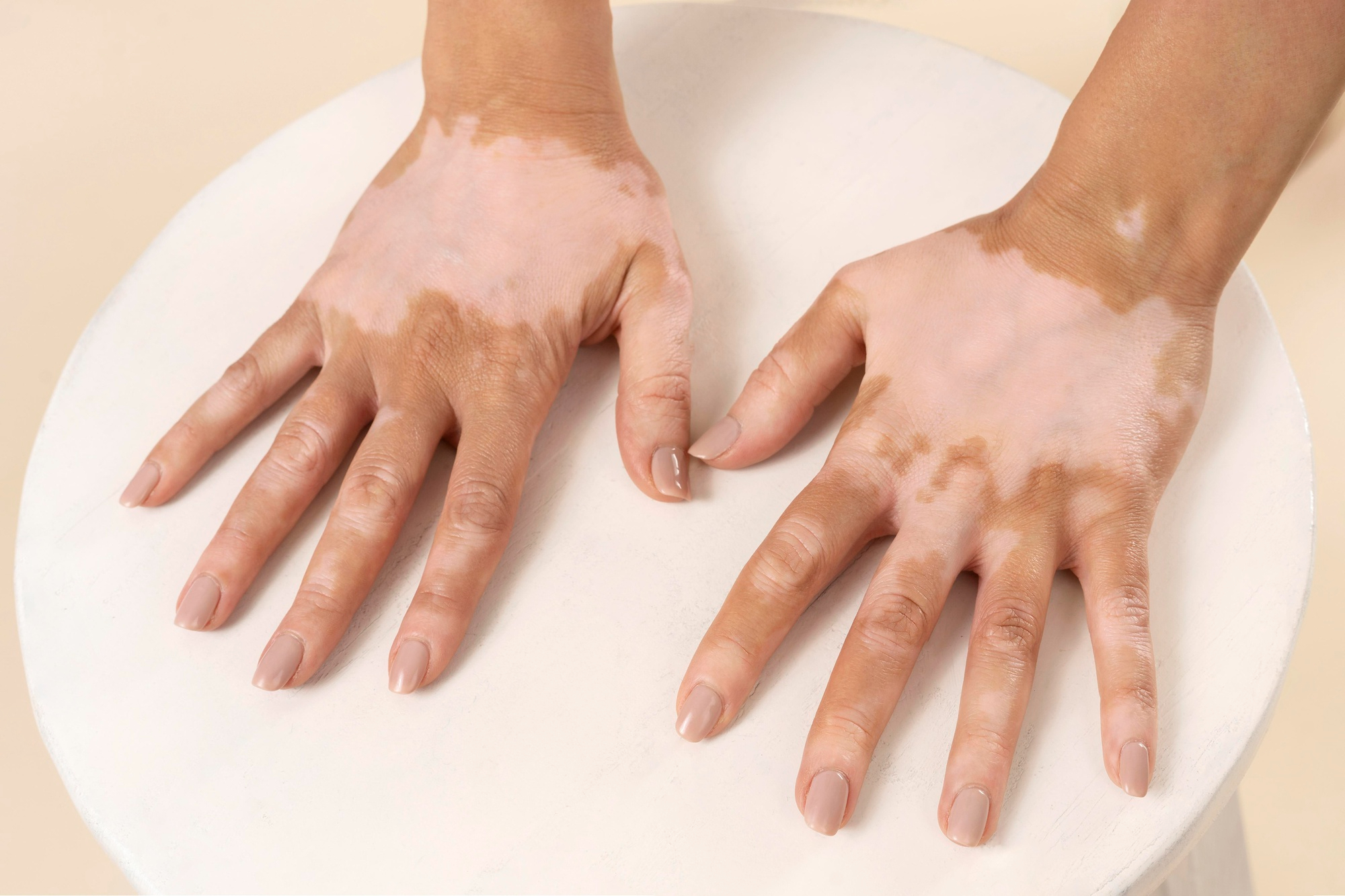 Vitiligo: Imagem de Freepik.