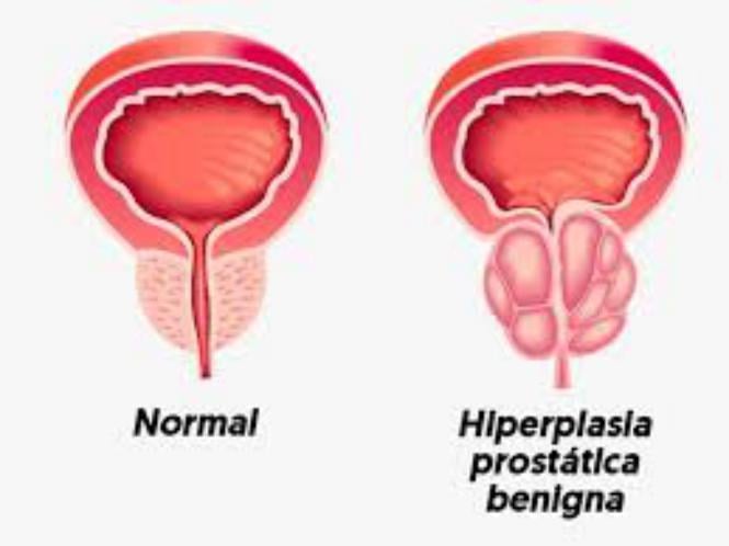 Tansulosina para hiperplasia prostatica benigna