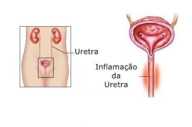 Cystex para uretrite