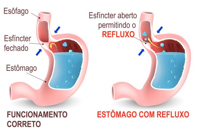 Esomeprazol para refluxo