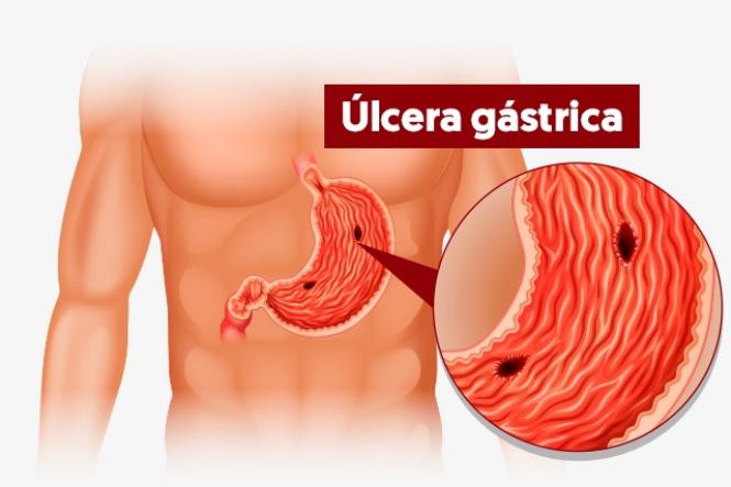 Esomex para ulcera gastrica