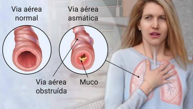 Flixotide para asma