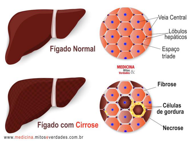 Legalon para cirrose hepatica 1