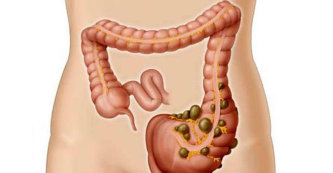 Mesalazina para diverticulite 1