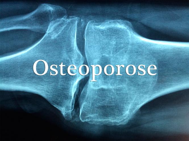 Osteoban 1