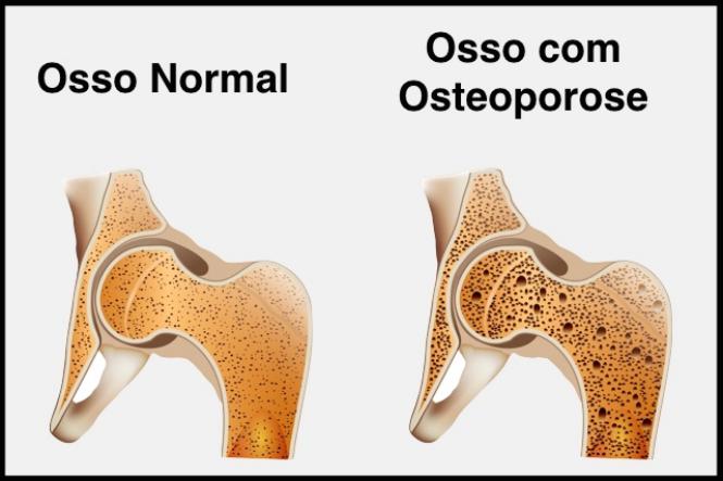 Prosso para osteoporose