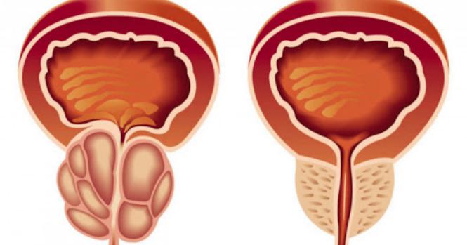 Imagem Complementar do Avodart - 0,5mg 30 comprimidos