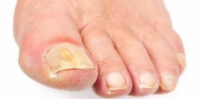 Imagem Complementar do estiranox itraconazol 100mg com 4 cápsulas