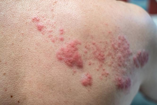 Imagem Complementar do Valtrex - 500mg 10 comprimidos