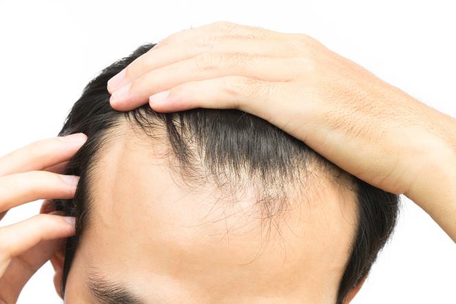Imagem Complementar do Aloxidil - Solução Capilar Com 50ml