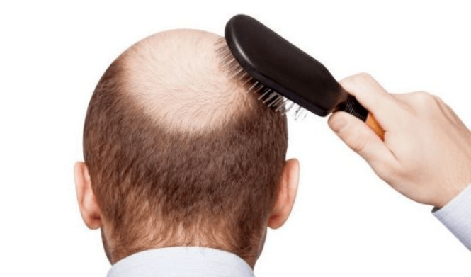 Imagem Complementar do Aloxidil - Solução Capilar Com 50ml