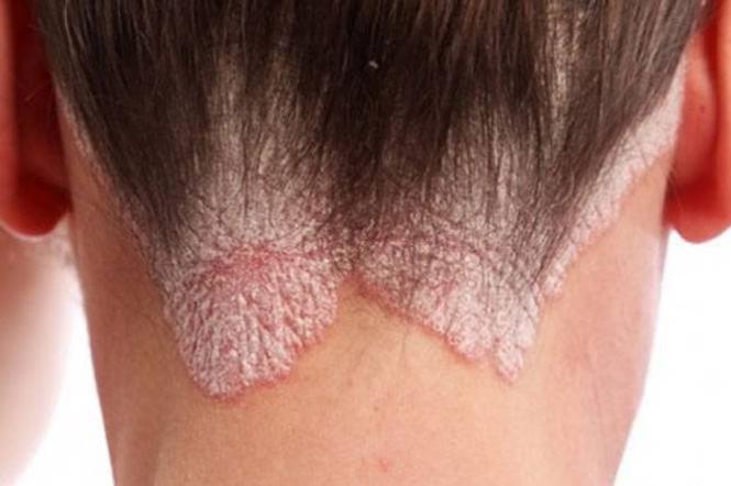 Imagem Complementar do Metrexato - 2,5mg c 24 comprimidos