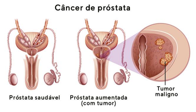 Bicalutamida