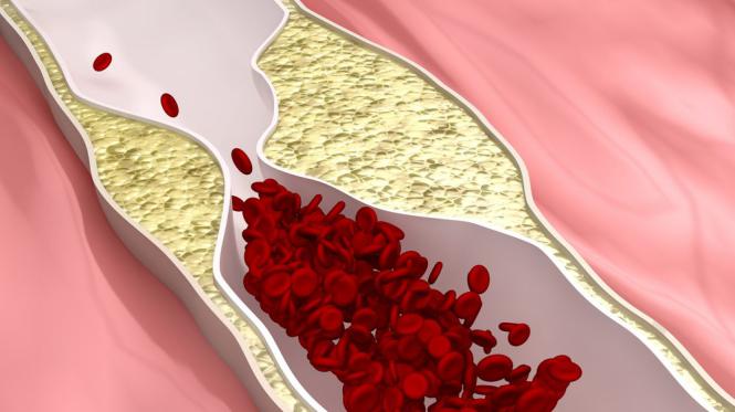 Bissulfato de Clopidogrel