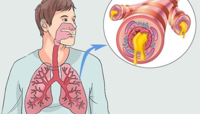 Imagem Complementar do Bronchovaxom - Infantil 3,5mg 10 cápsulas