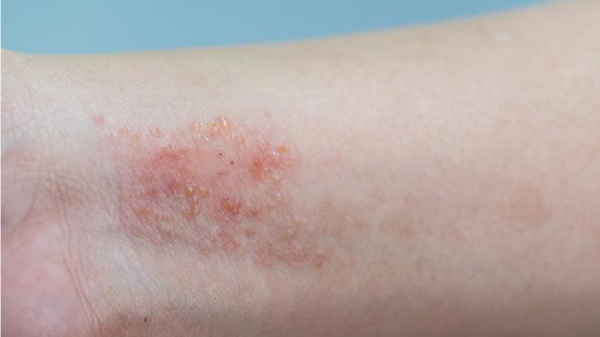 Imagem Complementar do Histamin - 20 comprimidos