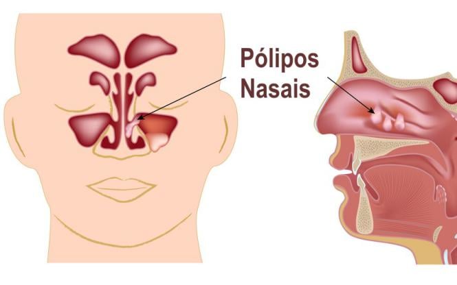 Budesonida para polipos nasais
