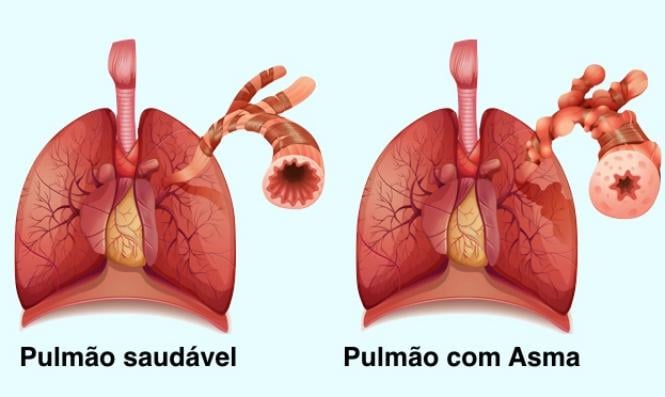 Aerolin para asma
