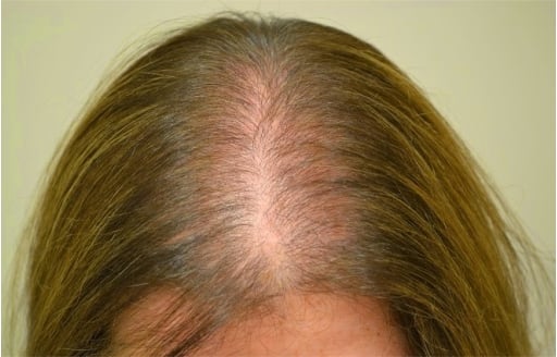 Avicis para Alopecia Androgenética