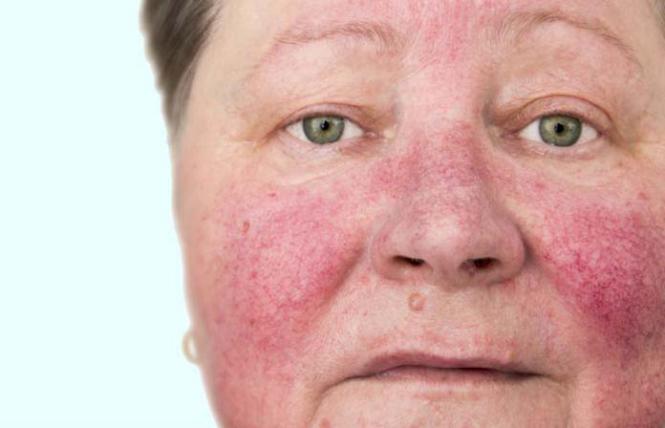 Cetaphil para rosacea