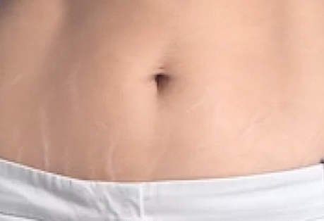 Imagem Complementar da Bula do loção corporal cicatricure antiestrias 400g