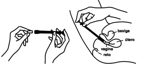 Imagem Complementar da Bula do Gino canesten - Creme vaginal 35g + 6 aplicadores