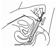Imagem Complementar da Bula do Gyno icaden creme vaginal 40g com 7 aplicadores