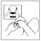 Imagem Complementar da Bula do Lupron - Depot 3,75Mg/Ml 1Fr + Diluente 2Ml