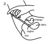Imagem Complementar da Bula do Clotrigel - Creme vaginal 20g+3aplic
