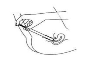 Imagem Complementar da Bula do Metronidazol - Nistatina creme vaginal 50g prat d prati donaduzzi genérico