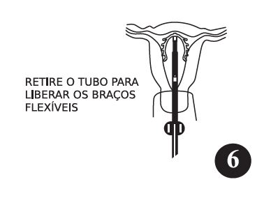 Imagem Complementar da Bula do diu cepeo omega cu 375 mini